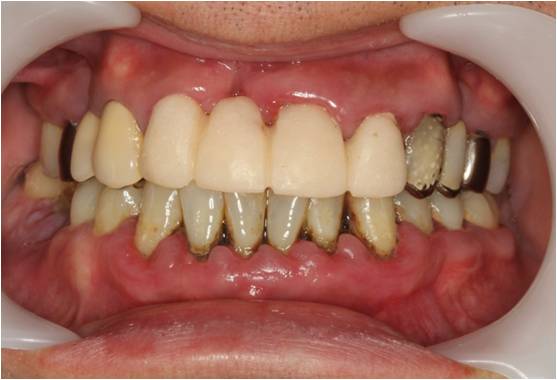 40代男性　歯周基本治療