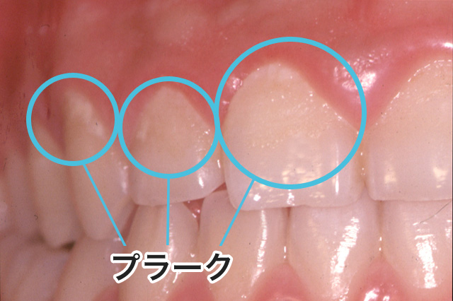 「歯垢」と「歯石」はどう違うの？