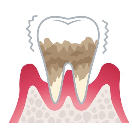 歯石を取ると歯周病は治る？